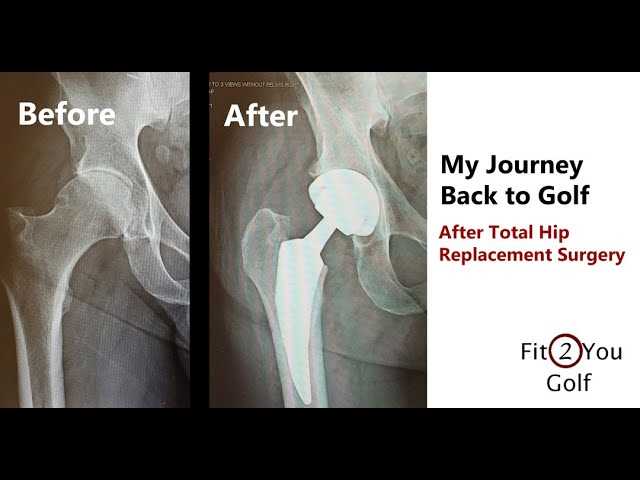 Best golf swing after hip replacement