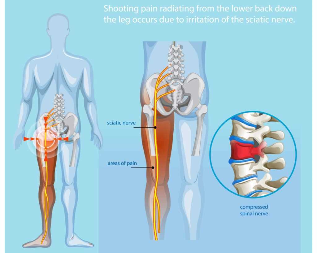 The Connection Between Golf Swing Mechanics and Back Pain