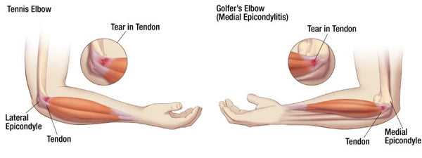 Preventive Measures to Avoid Tennis Elbow While Playing Golf