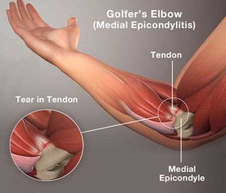 When to Seek Professional Help for Golf-Related Elbow Issues