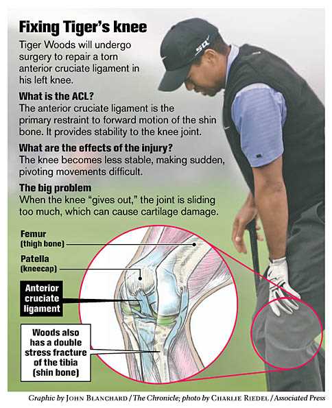 Choosing the Right Equipment for Playing with an ACL Injury